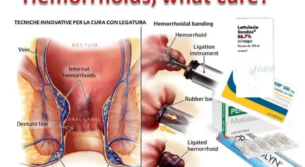 Illustrazione anatomica emorroidi e tecniche di legatura. Farmaci come Pentacol a cosa serve per il trattamento.