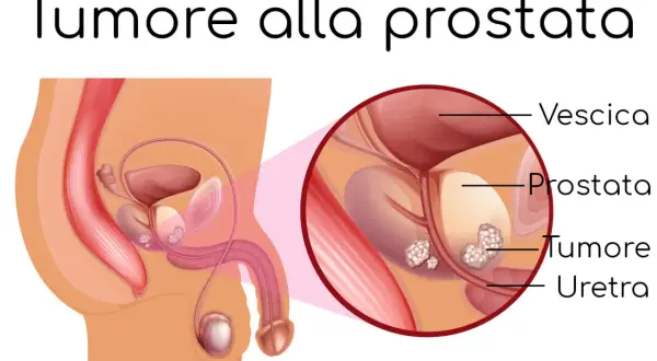 Illustrazione anatomica della prostata con tumore. La diagnosi precoce è fondamentale: il tumore alla prostata si guarisce.