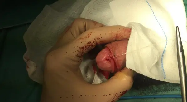 Mano guantata che esegue la circoncisione di un bambino. Si vedono suture e garze.