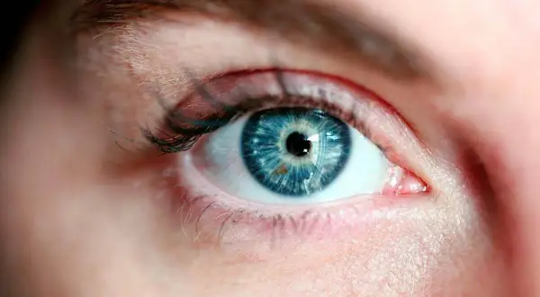 Occhio azzurro con iride dettagliata. Potrebbe essere un caso di cataratta giovanile, che rende l'occhio opaco.