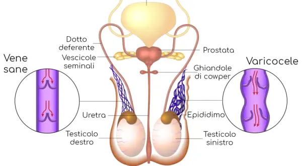 Illustrazione anatomica del sistema riproduttivo maschile. A destra, un varicocele mostra vene dilatate e gonfie, suggerendo testicoli gonfi.
