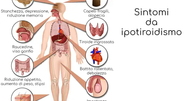 Ipotiridismo: stanchezza, depressione, problemi di memoria, ingrossamento della tiroide e altri sintomi.