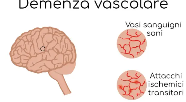 Illustrazione del cervello con la scritta "Demenza vascolare". A destra, vasi sanguigni sani e vasi colpiti da attacchi ischemici transitori.