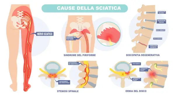 Illustrazione delle cause della sciatica: nervo sciatico infiammato, sindrome del piriforme, discopatia degenerativa, stenosi spinale ed ernia del disco.