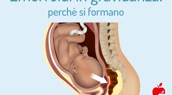 Illustrazione anatomica che mostra il feto nell'utero e la causa delle emorroidi in gravidanza, con un'area evidenziata.