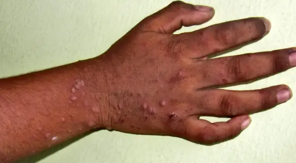 Mani e avambraccio con lesioni cutanee, possibili sintomi di una malattia che colpisce mani, bocca e piedi.