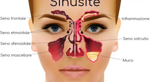 Illustrazione anatomica dei seni paranasali, evidenziando infiammazione e muco, causa comune di mal di testa da sinusite.