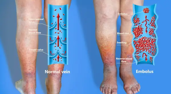 Gambe gonfie e arrossate, con un'illustrazione che mostra la flebite gamba sintomi: un trombo blocca il flusso sanguigno.
