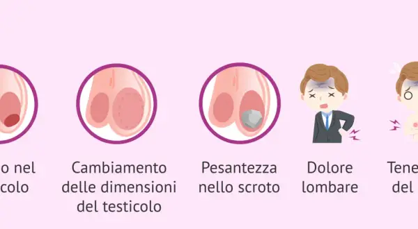 Illustrazione di sintomi: nodulo, cambiamento dimensioni testicolo, pesantezza scroto, dolore lombare, tenerezza seno. Possibile dolore testicolo sinistro.