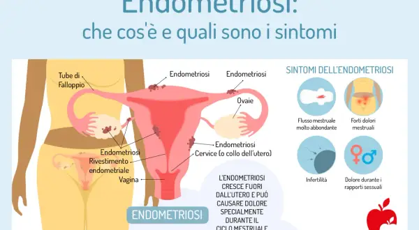 Illustrazione anatomica dell'utero e delle ovaie che mostra la crescita di tessuto endometriale fuori dall'utero, con i principali sintomi dell'endometriosi: flusso abbondante, dolori mestruali, infertilità e dolore durante i rapporti sessuali.
