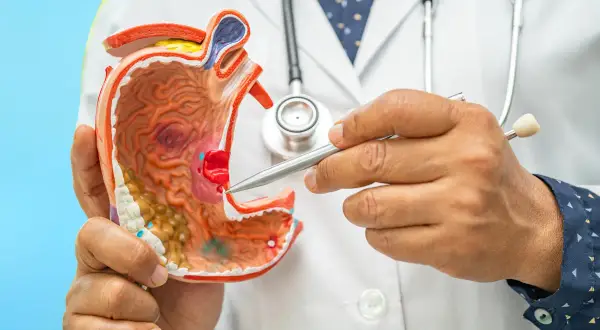 Modello anatomico dello stomaco, con un dito che indica un'area che potrebbe rappresentare una gastropatia antrale.