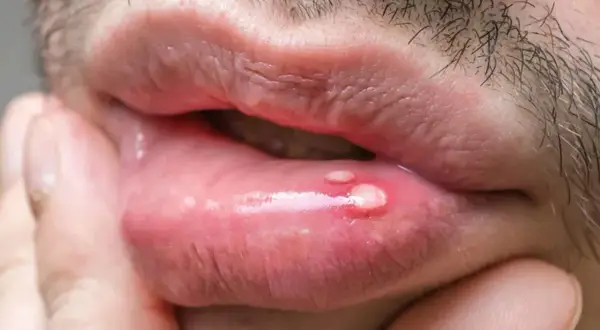Uomo con lesioni sulle labbra, possibili manifestazioni del papilloma virus.