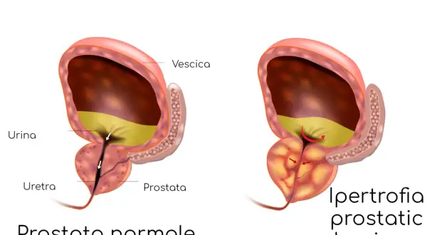 Confronto tra prostata normale e prostata ingrossata: sintomi e cure. L'ipertrofia prostatica benigna comprime l'uretra, ostacolando il flusso urinario.