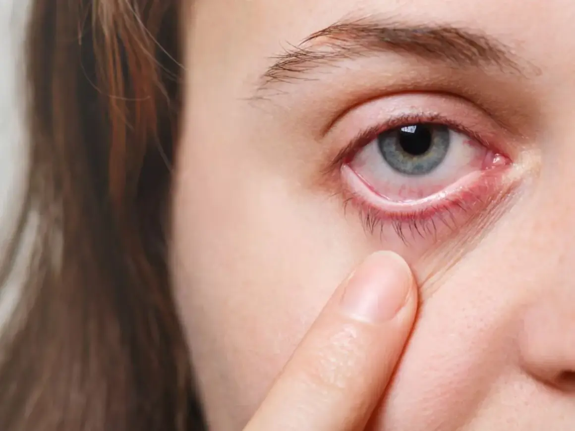 Occhio arrossato e irritato, con palpebra inferiore visibilmente infiammata, sintomo di congiuntivite allergica.