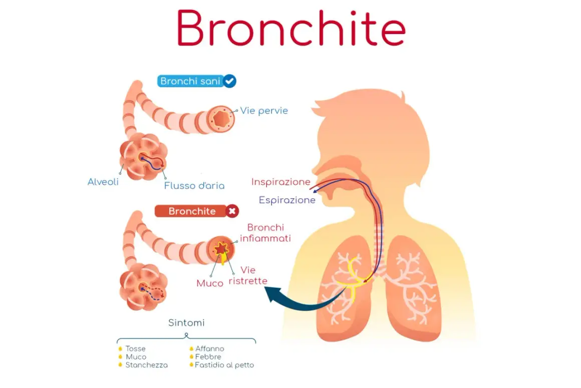 Illustrazione della bronchite: vie aeree sane e infiammate, con sintomi. Potrebbe essere utile un antibiotico per bronchite.