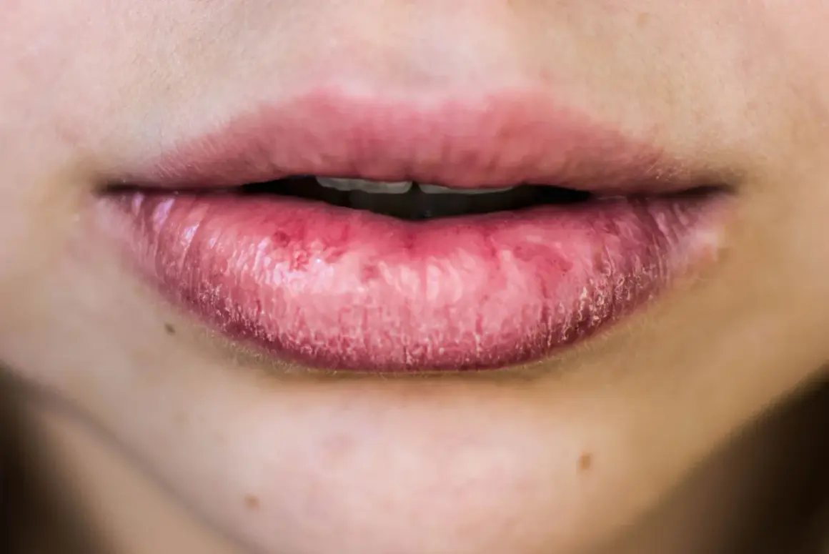 Labbra secche e screpolate, possibili cause psicologiche legate a stress o ansia.