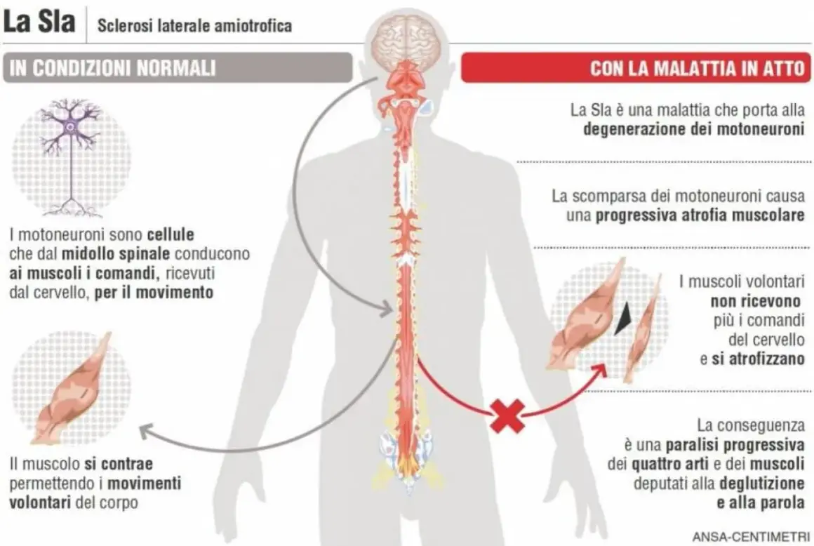 Illustrazione sui sintomi SLA: degenerazione dei motoneuroni, atrofia muscolare e paralisi progressiva.