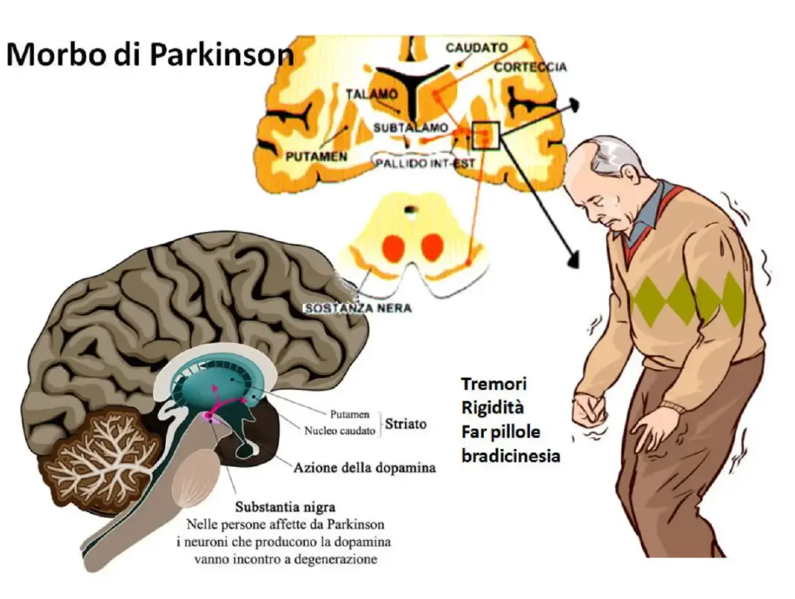 Illustrazione del cervello e di un uomo con tremori, sintomi del Parkinson. La sostanza nera degenera, influenzando la dopamina. Non si specifica in quanto tempo degenera il parkinson.