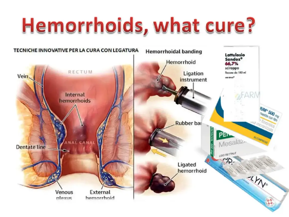 Illustrazione anatomica emorroidi e tecniche di legatura. Farmaci come Pentacol a cosa serve per il trattamento.