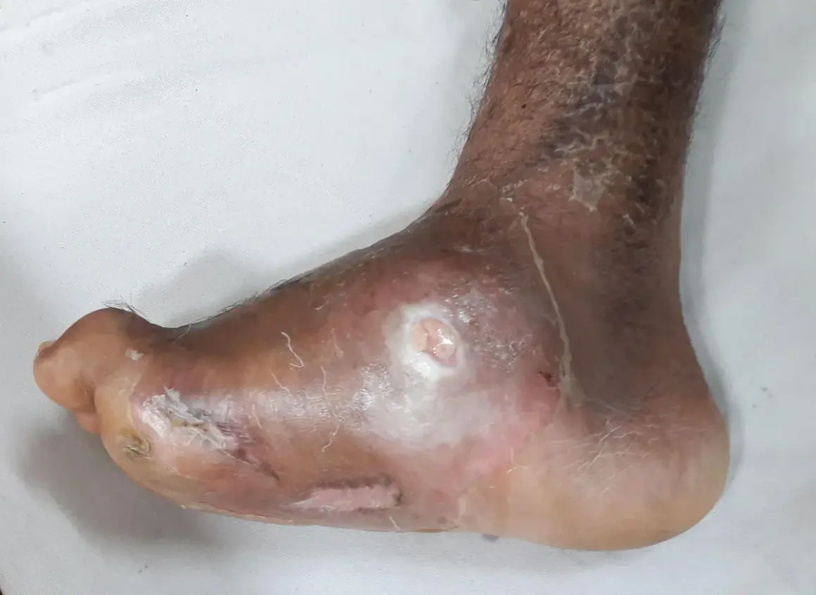 Piede con lesioni cutanee e ulcere, possibili forxiga effetti collaterali. Pelle secca e screpolata sulla caviglia.