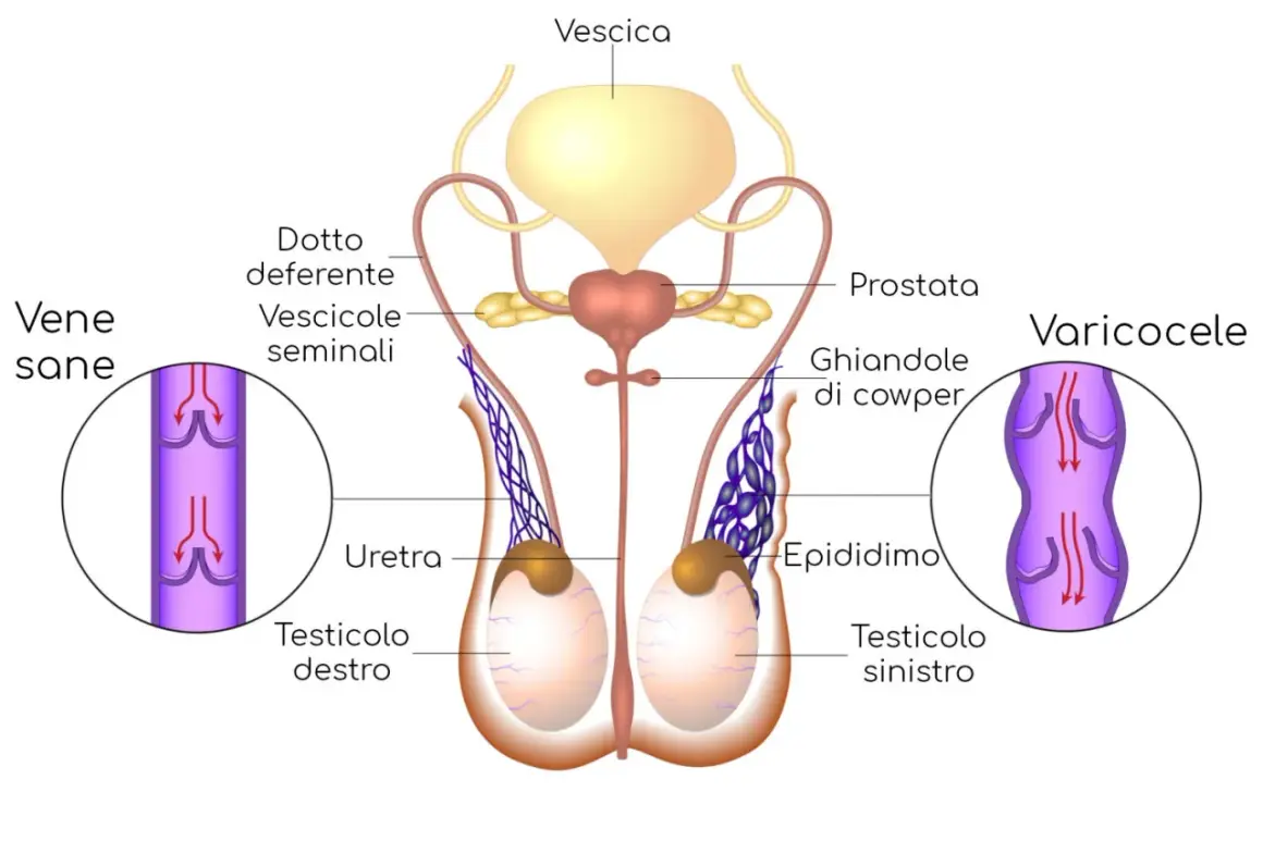 Illustrazione anatomica del sistema riproduttivo maschile. A destra, un varicocele mostra vene dilatate e gonfie, suggerendo testicoli gonfi.