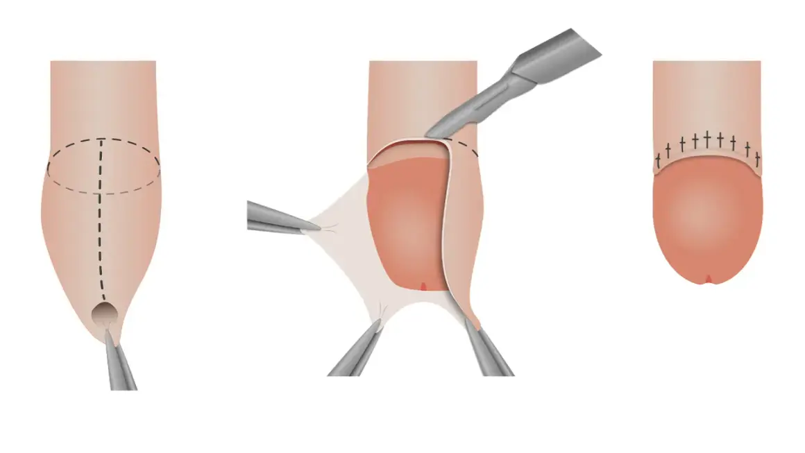 Illustrazione di un pene non circonciso durante un intervento chirurgico, con rimozione del prepuzio e sutura.