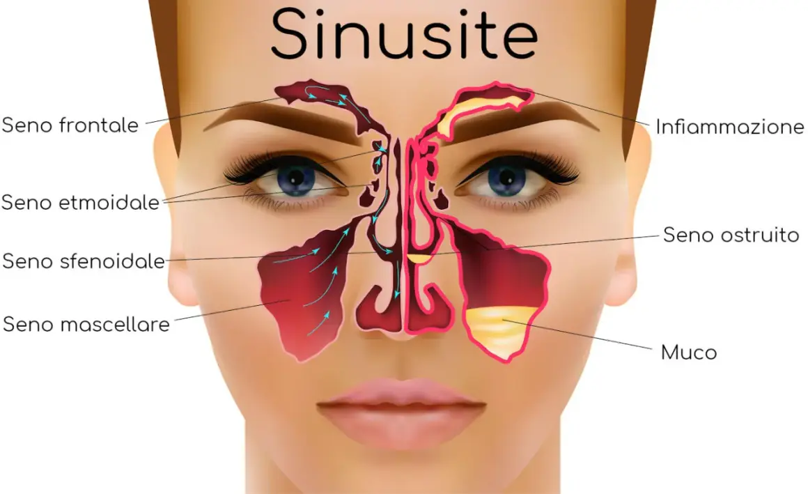 Illustrazione anatomica dei seni paranasali, evidenziando infiammazione e muco, causa comune di mal di testa da sinusite.