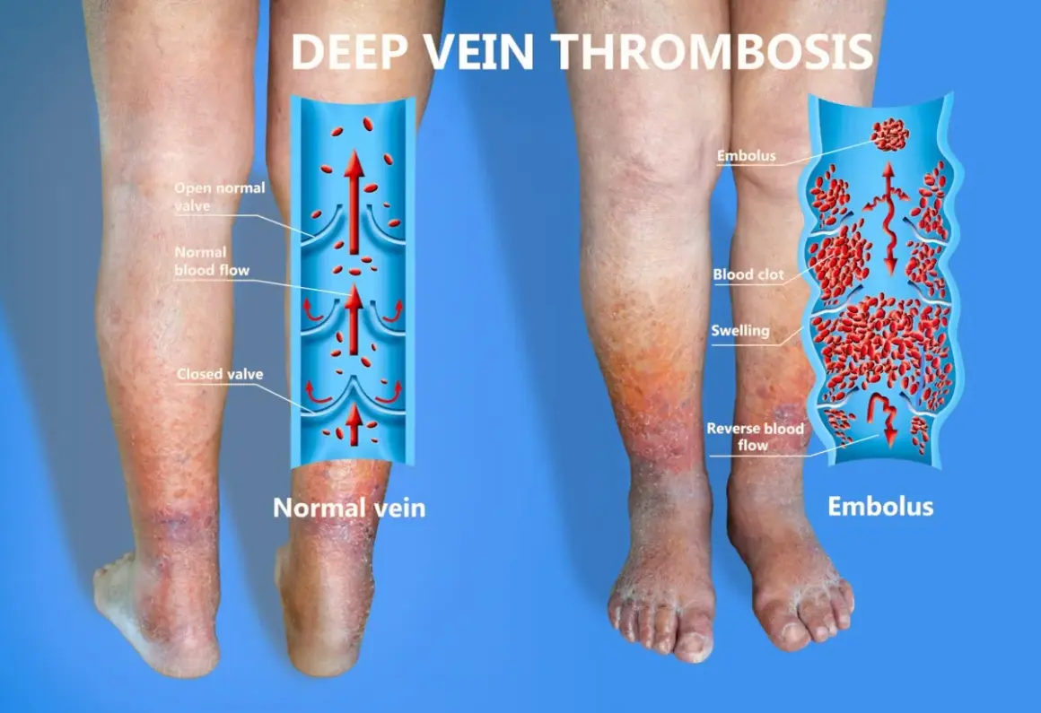 Gambe gonfie e arrossate, con un'illustrazione che mostra la flebite gamba sintomi: un trombo blocca il flusso sanguigno.