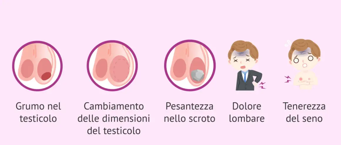 Illustrazione di sintomi: nodulo, cambiamento dimensioni testicolo, pesantezza scroto, dolore lombare, tenerezza seno. Possibile dolore testicolo sinistro.
