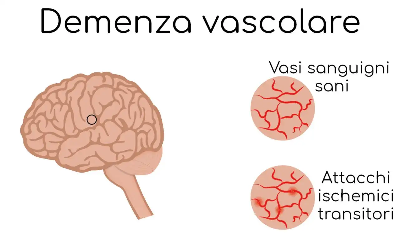 Demenza vascolare - sintomi, diagnosi e come proteggere l’autonomia