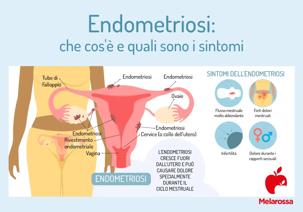 Endometriosi, i sintomi da riconoscere e quando farsi visitare