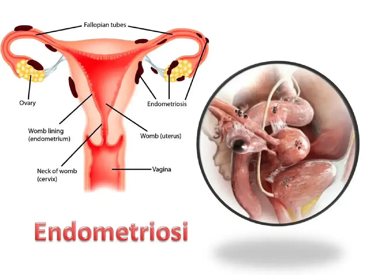 Illustrazione anatomica dell'utero e delle ovaie che mostra la crescita anomala di tessuto, un sintomo dell'endometriosi.