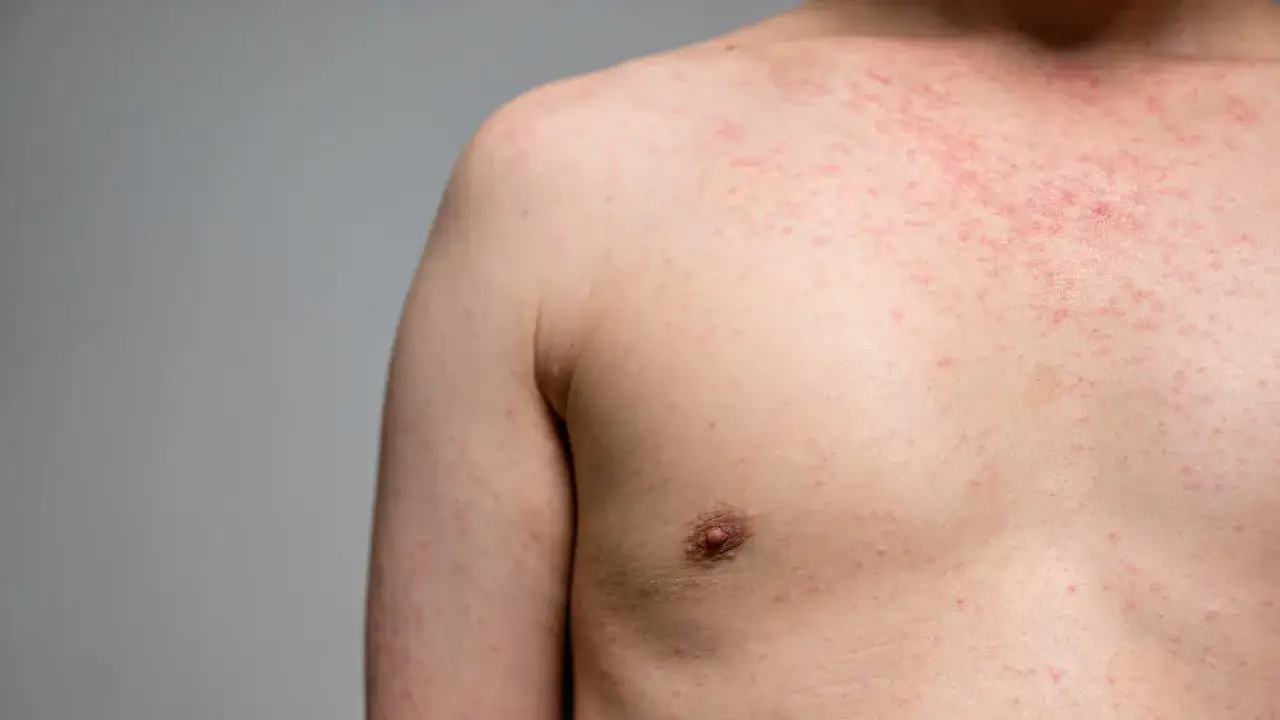 Eruzione cutanea rossa sul petto e sulla spalla, possibile sintomo di febbre da stress.