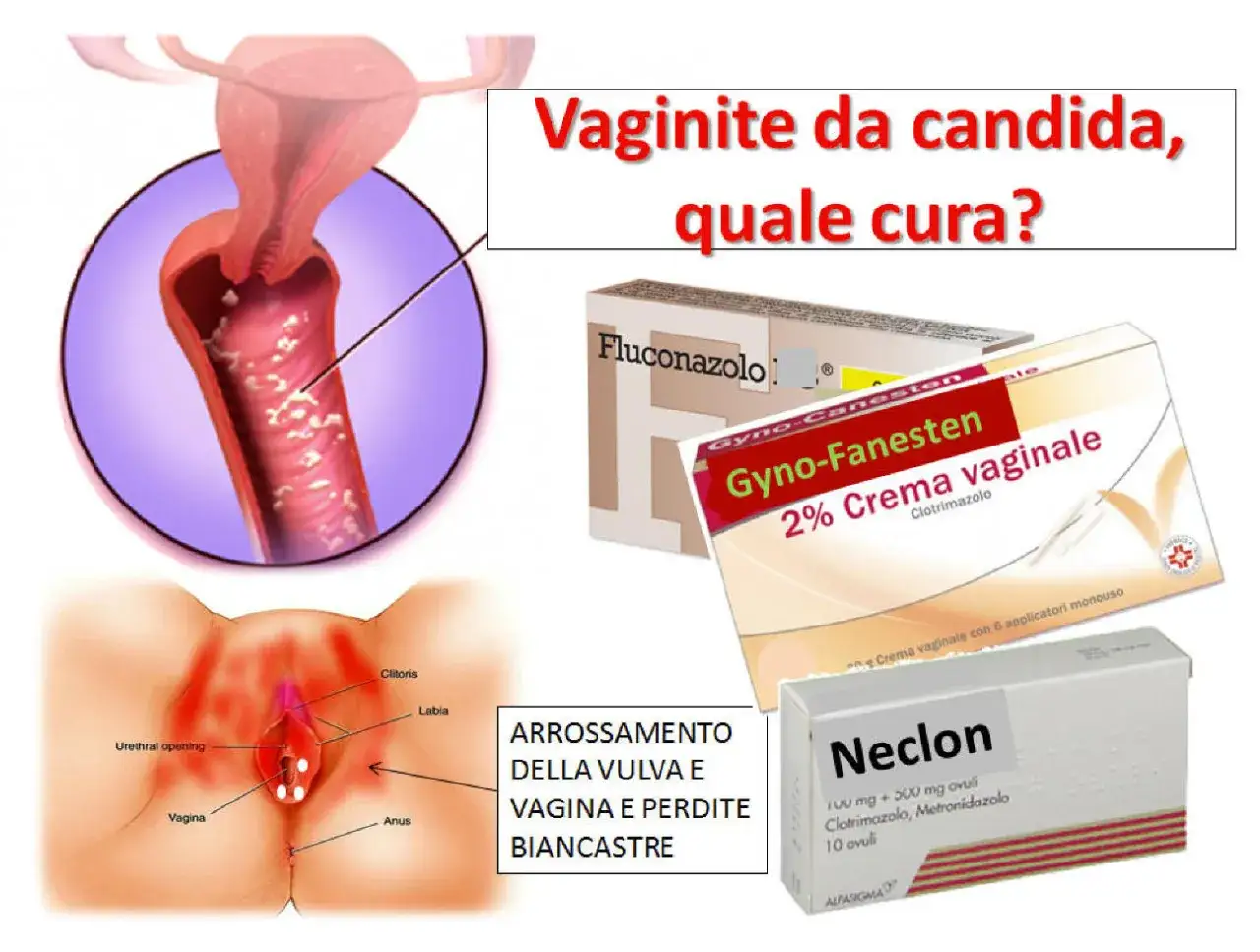Vaginite da candida: rimedi come Gyno-Fanesten e Neclon. Immagine illustra infezione e arrossamento vulvare, utile anche per chi cerca informazioni sui funghi in gravidanza.