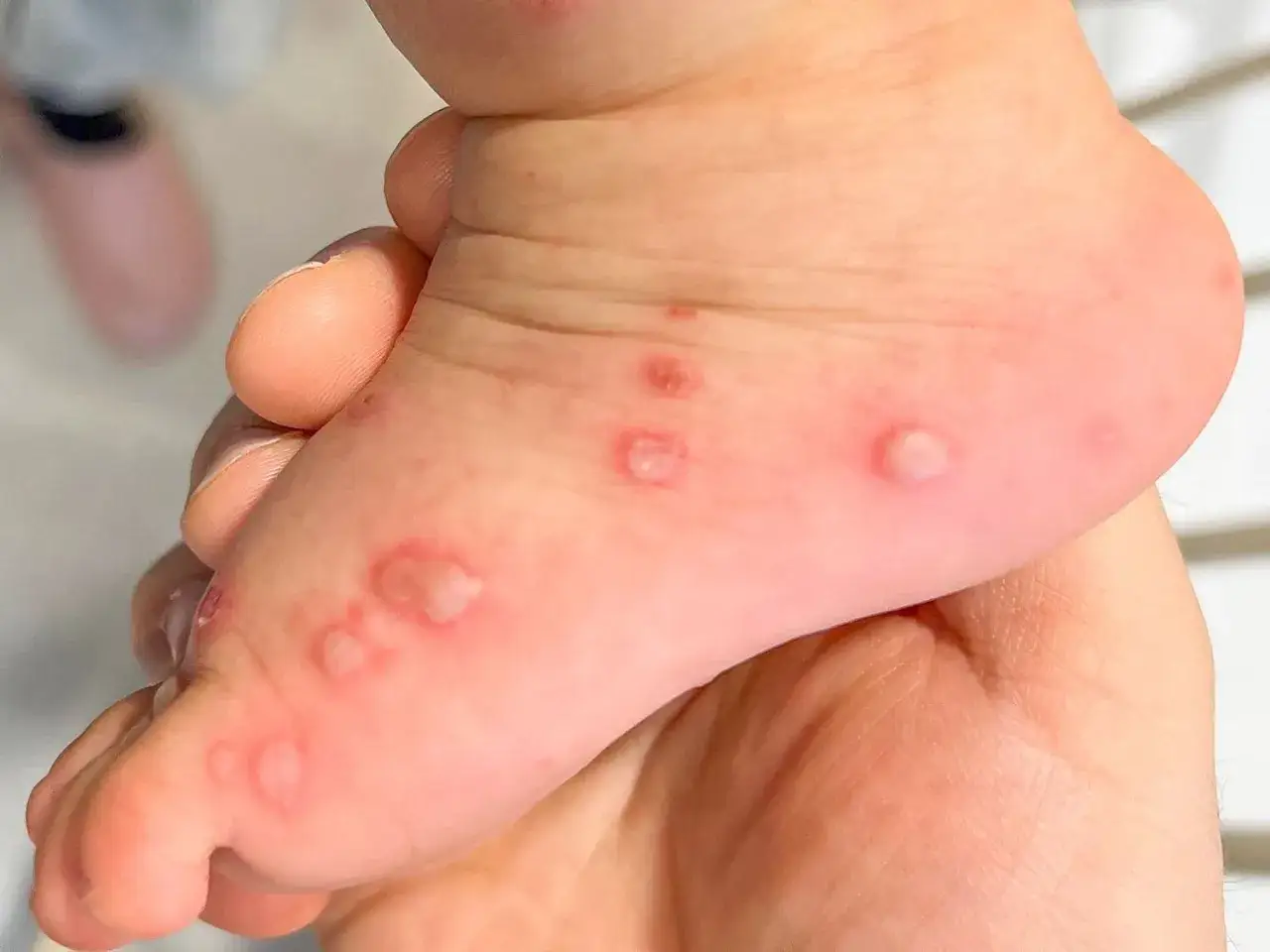 Piedi di bambino con vescicole rosse e bianche, possibili sintomi di mani, bocca e piedi.