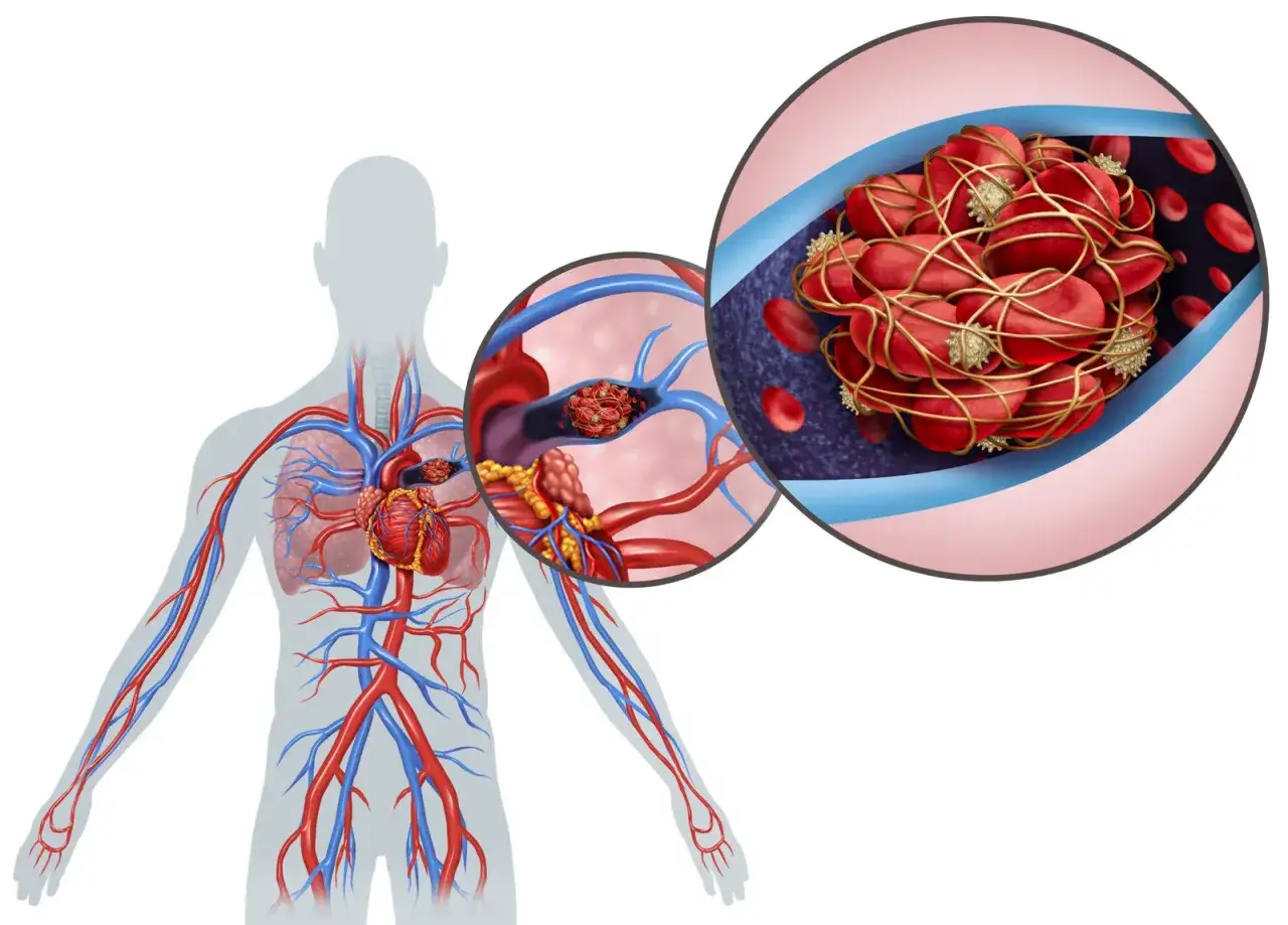Schema del corpo umano con un trombo in un vaso sanguigno. L'embolia polmonare influisce sull'aspettativa di vita.