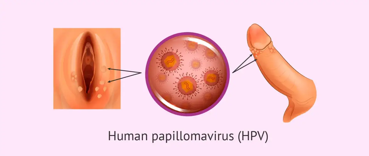 Illustrazione dell'HPV: condilomi uomo e genitali femminili, con ingrandimento del virus.