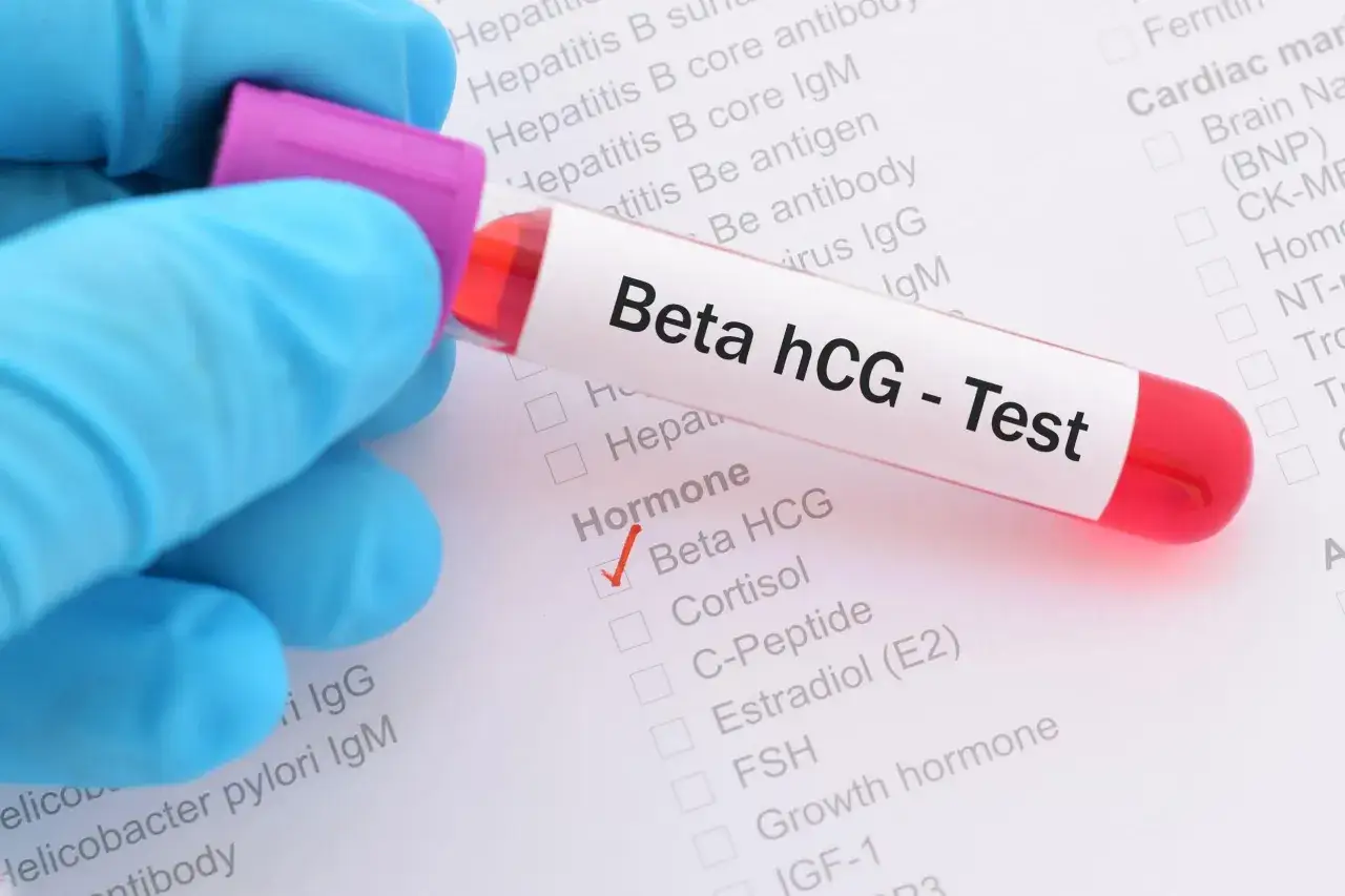 Provette con campione di sangue per test beta hCG. Il campione &egrave; etichettato 