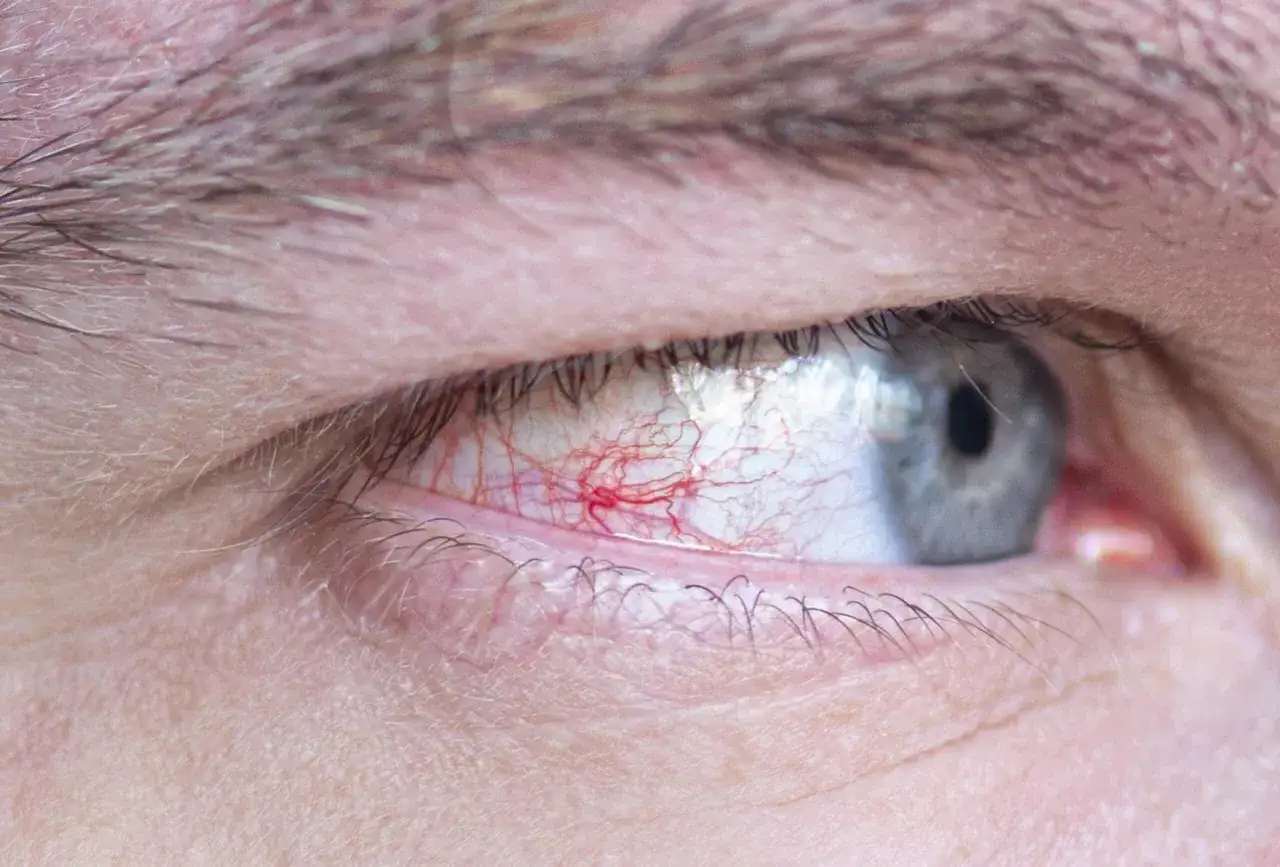 Occhio con forte arrossamento e vasi sanguigni dilatati, sintomo di congiuntivite allergica.