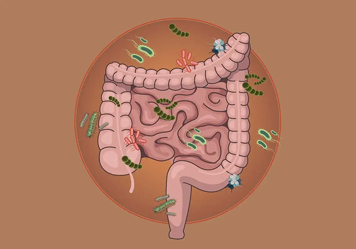 Illustrazione dell'intestino con batteri e funghi, che potrebbero indicare i candida intestinale sintomi.