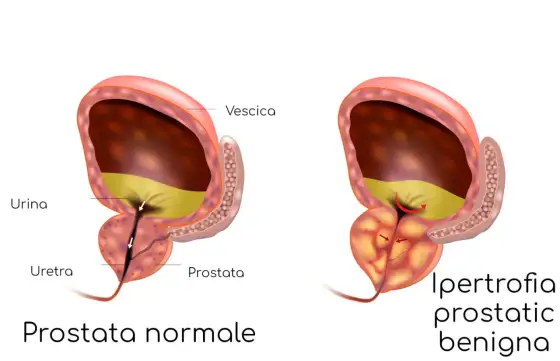 Prostata ingrossata, sintomi e cure - cosa sapere
