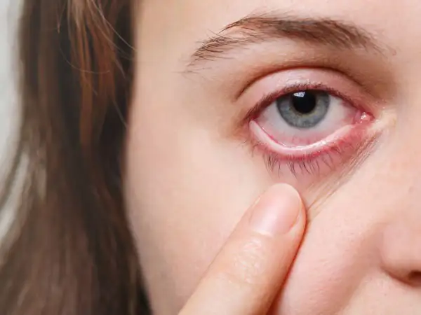 Occhio arrossato e irritato, con palpebra inferiore visibilmente infiammata, sintomo di congiuntivite allergica.