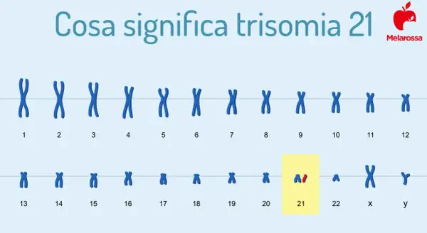 Il cariotipo mostra la trisomia 21, la causa della sindrome di Down. Le cause di morte in questi casi sono spesso legate a complicazioni cardiache o respiratorie.