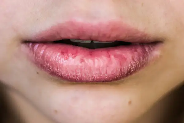 Labbra secche e screpolate, possibili cause psicologiche legate a stress o ansia.