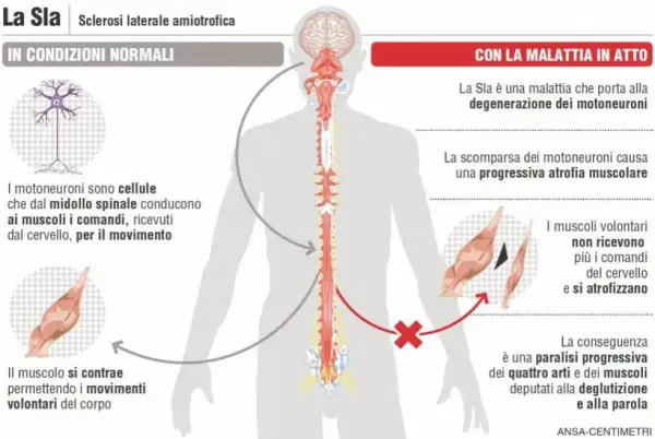 Illustrazione sui sintomi SLA: degenerazione dei motoneuroni, atrofia muscolare e paralisi progressiva.