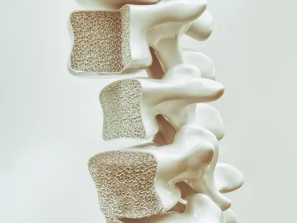 Sezione di vertebre con osso spugnoso. Prolia a cosa serve: aiuta a rafforzare le ossa fragili, contrastando l'osteoporosi.