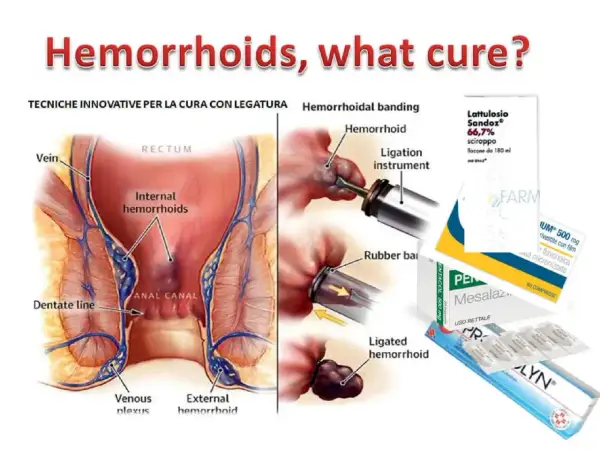 Illustrazione anatomica emorroidi e tecniche di legatura. Farmaci come Pentacol a cosa serve per il trattamento.