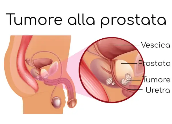 Illustrazione anatomica della prostata con tumore. La diagnosi precoce è fondamentale: il tumore alla prostata si guarisce.