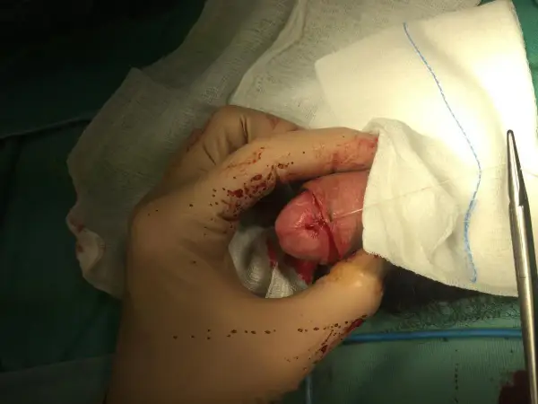 Mano guantata che esegue la circoncisione di un bambino. Si vedono suture e garze.