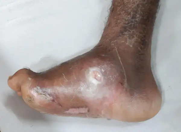Piede con lesioni cutanee e ulcere, possibili forxiga effetti collaterali. Pelle secca e screpolata sulla caviglia.